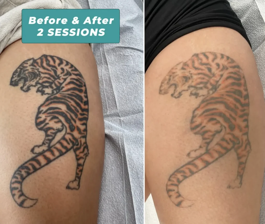 laser tattoo removal healing process