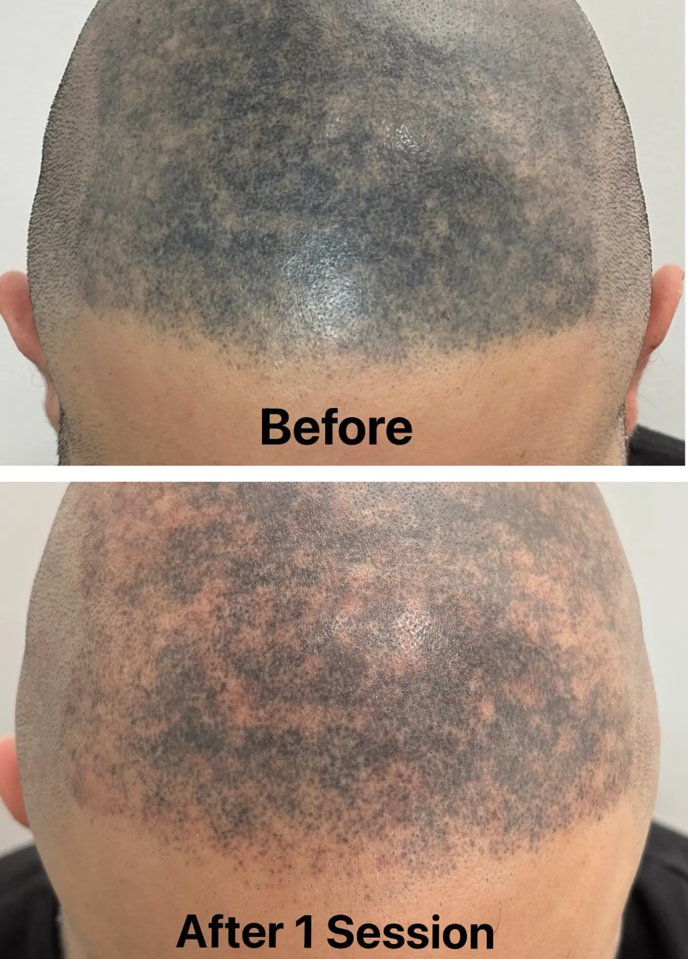 laser tattoo removal