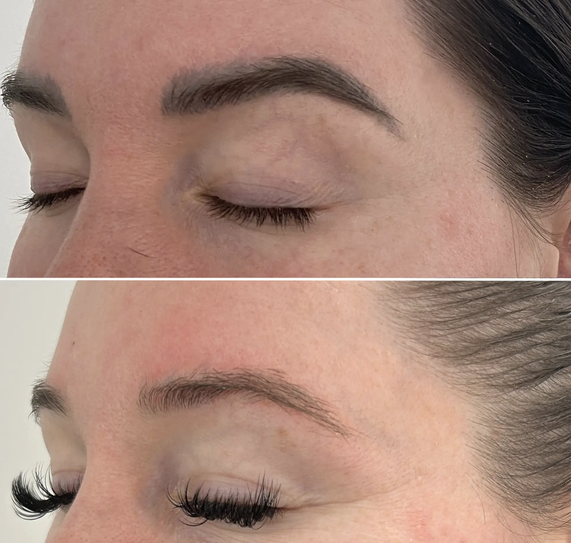 tattoo removal aftercare
